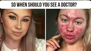 Acne, Acne, Acne
