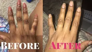 How To Cleaning Dark Knuckles And Brighten Hand At Home | Smart Solutions.
