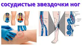 Как убрать капиллярные сеточки на ногах БЕЗ ОПЕРАЦИИ