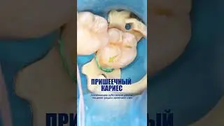 Наши стоматологи-терапевты как настоящие скульпторы воспроизводят природный рельеф зуба