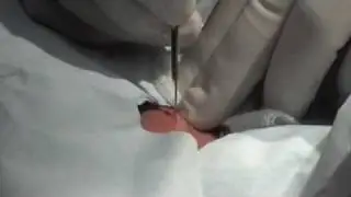 Awesome Zit Cyst Surgery