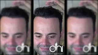 Dhi Clinic Turkey - Hair Transplant -Öncesi Sonrası / Mükemmel Saç Ekim Sonucu / Bir Yıl Sonra 2023