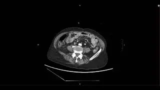 Abdominal Imaging Call Prep Cases: C​l​o​s​e​d​ ​L​o​o​p​ ​SBO (CT) Case 1 Discussion