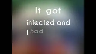 Nasty Brown Recluse Spider Bite Healed at Home