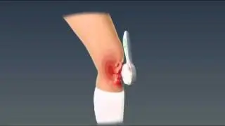 QVC SKN A222333 Knee Penetration 1