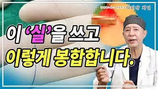초박피 포경수술 할 때 사용하는 실(봉합사)과 봉합 모습