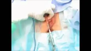Bioplastia Vaginal (Remodelação Grandes Lábios)