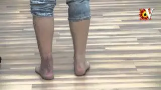 Разрыв ахилла, лечение и реабилитация.