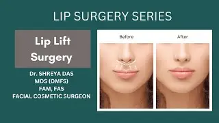 Facial Cosmetic Surgery | Lip Lift Surgery