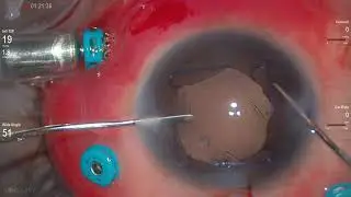 Malyugin Ring: Insertion, Rotation and Removal