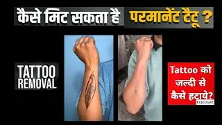 Tattoo Removal I टैटू हटाने की सर्जरी I टैटू निकालने की सर्जरी I Permanent Surgical Tattoo removal