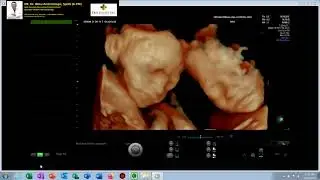 IDENTICAL TWINS IN NORMAL PREGNANCY (Dr. Wiku Andonotopo)