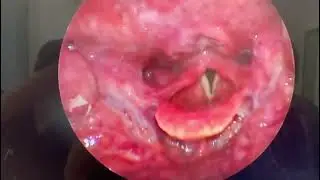 #hypopharyngealcancer
