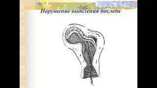 Акушерские кровотечения, часть 2