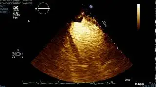Brown Clinical Image of the Month: Lambls LV Thrombus Echo 4