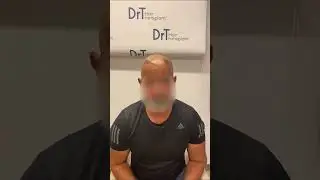 Experience of our patient at DrT Hair!#DrTayfunOguzoglu #Hairtransplant #HairTransformation