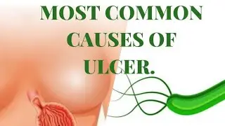 Causes of *STOMACH ULCER*// H-PYLORI//Ways of *TRANSMISSION* //Types of Ulcer.