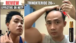 Trinoxteride 20++ Review: RESULT after using for 1 month | Effective or Not?