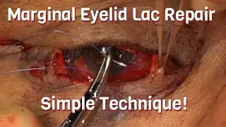 Eyelid Laceration Repair - Simple Technique | Ron Mancini, MD, FACS; Zac Keenum, MD