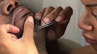 My Husband's Ingrown Hairs & Beard Flakes