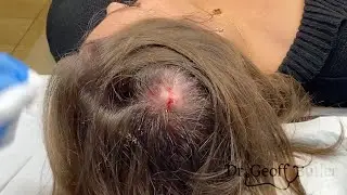 Drainage of an Infected Pilar Cyst