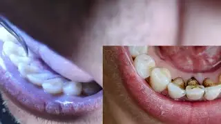 Pulizia dei denti con ultrasuoni come dal dentista fai da te