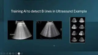 AI (Artificial Intelligence) in Ultrasound