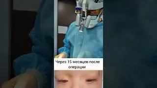 Друзья, вашему вниманию хотел бы показать результат после операции, спустя несколько лет.⌛