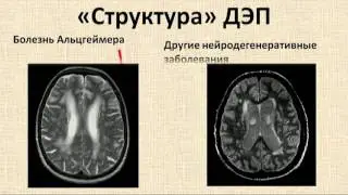 Дисциркуляторная энцефалопатия