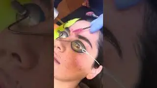 Cosmetic brow tattoo removal at Well Medical arts in Seattle