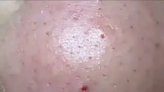 Removendo CRAVOS GRANDES do nariz 👃😮 - satisfatório