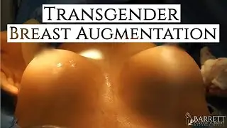 Dr Barrett's Transgender Breast Augmentation | Transgender Breast Surgery