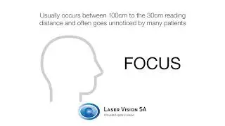Vision after Trifocal Implants
