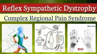 Reflex Sympathetic Dystrophy Syndrome (RDS) | Complex Regional Pain Syndrome