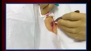 WCW: Removing an Atypical Lesion