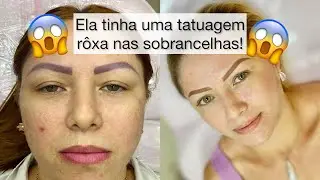 Correção de sobrancelhas arroxeadas