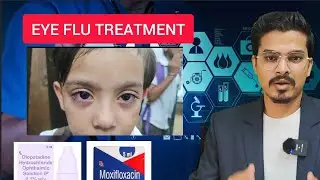 Eye flu treatment ✨