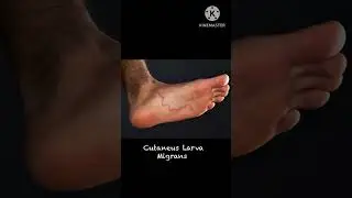Pengobatan Cutaneus Larva Migrans dengan menggunakan mebendazole