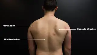 ACUPUNCTURE FOR DAMP PAIN (SHOULDER PAIN) ON SI & SJ MERIDIANS (PRESSURE PAIN)
