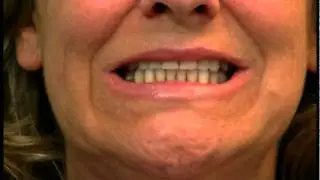 Dental Sleep Med Systems Presents The Airway Metrics System and Bite Registration