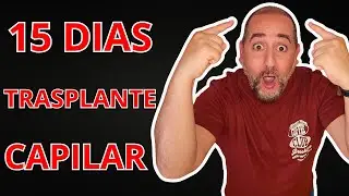 My real experience with a hair transplant in the first 15 days