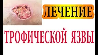 How to cure a trophic ulcer. Diabetes. Erysipelas. Varicose veins. Malinovsky
