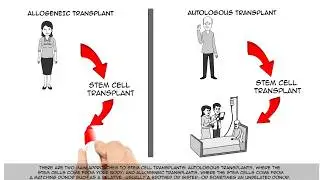 Multiple Myeloma Stem Cell Transplant