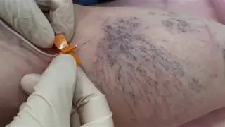 Склеротерапия Ангиолайф
