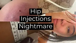 HIP DIP SCULPTRA INJECTIONS GONE WRONG + Illegal Shots