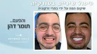 טיפולי שיניים בטורקיה עם ביונד סמייל - החיוך החדש של תומר
