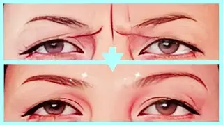 ⏸️FROWN LINES CUPPING MASSAGE (NO TALKING)⏸️11 LINES, GLABELLAR LINES, BETWEEN EYES WRINKLES