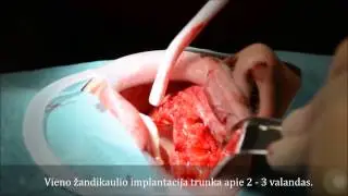 All-on-4® operacija. 4 atvejai. "Papadent" odontologijos klinika.