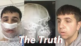 5 Things You Need To Know Before Your Open Jaw Surgery | My Story