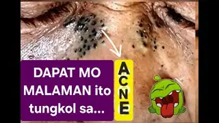 IF YOU KNOW THIS ABOUT ACNE, You Won't Jump From One Treatment to the Next 